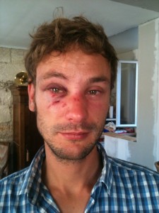 Agression homophobe à Bordeaux : Nicolas témoigne